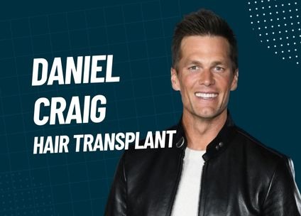 Daniel Craig hair transplant