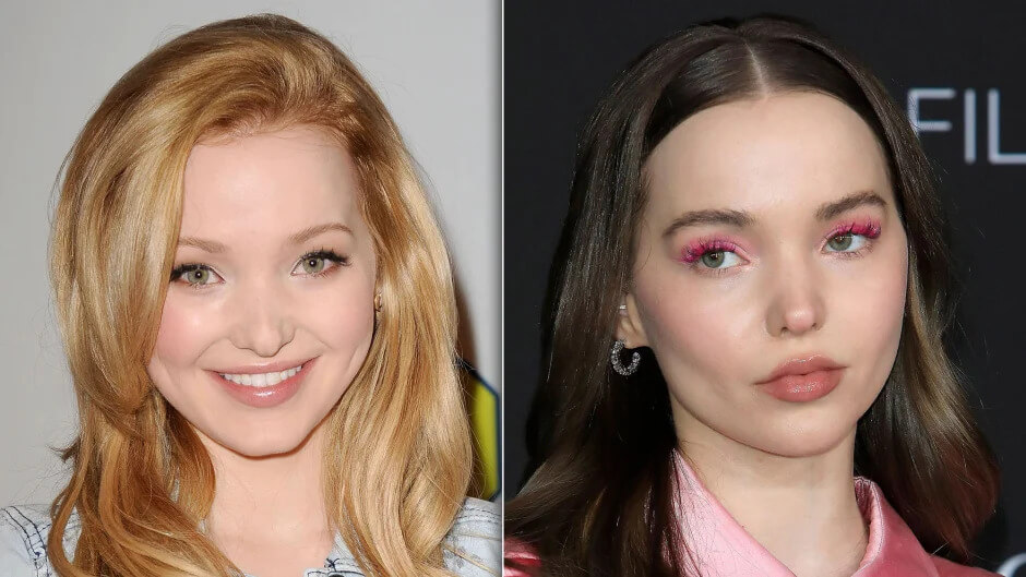 dove-cameron-plastic-surgery