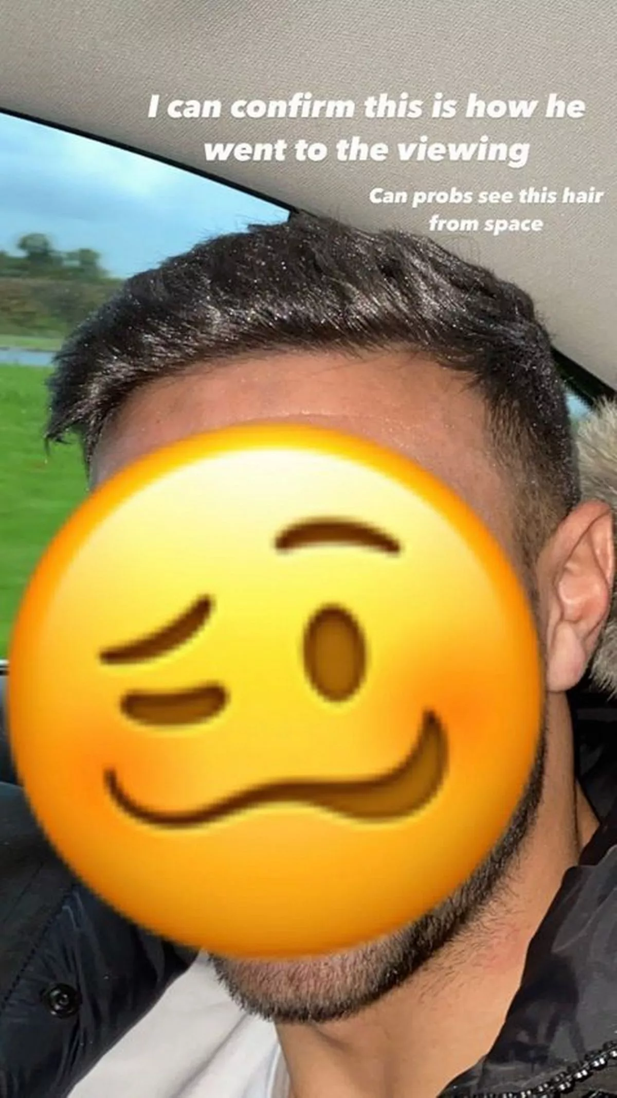 Tommy Fury hair transplant