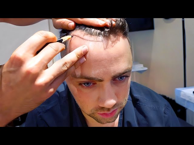 Mizkif Hair Transplant