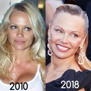 Pamela Anderson Facelift before after