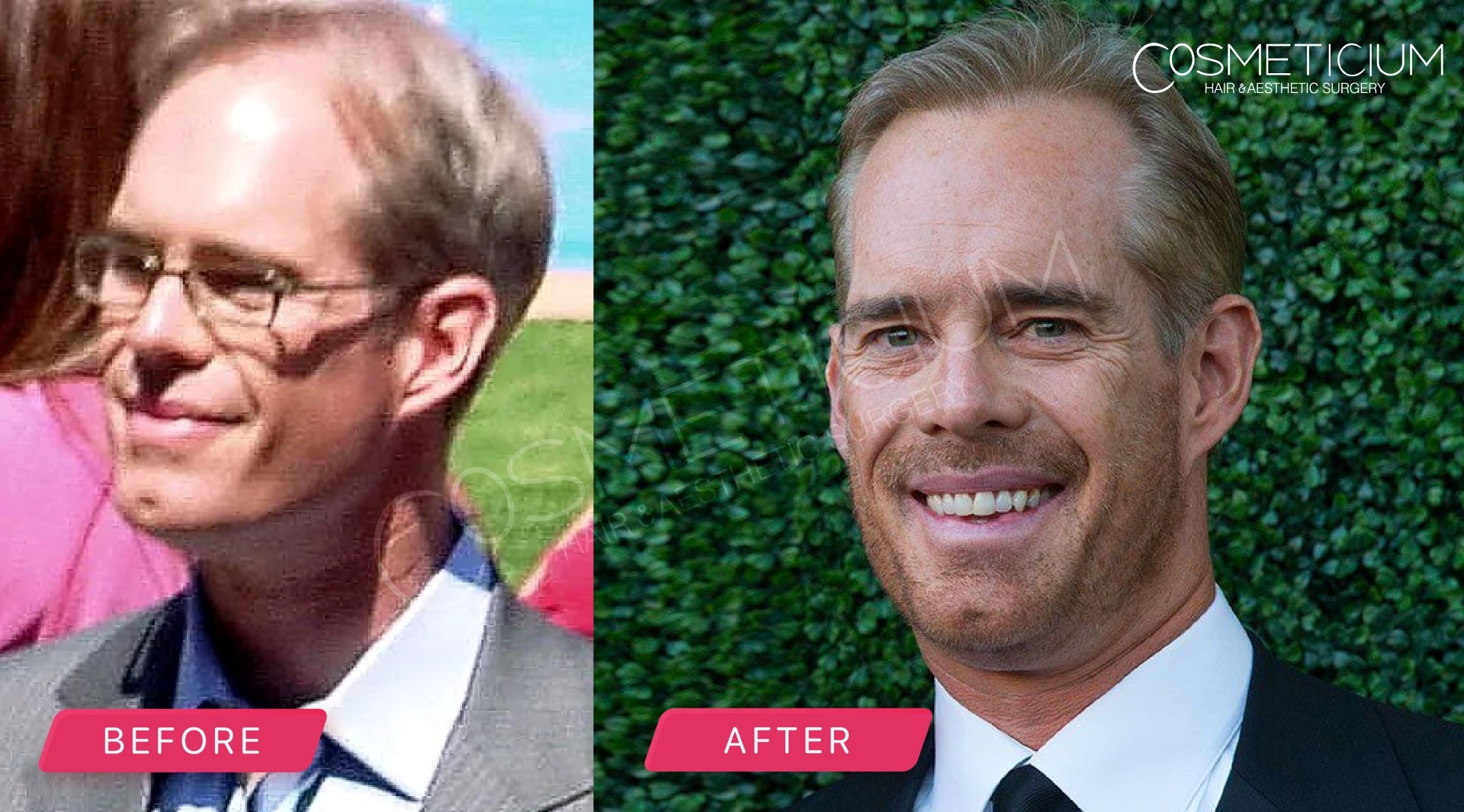 Joe Buck Hair Transplant before after