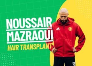 mazraoui hair transplant