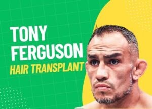 tony ferguson hair transplant