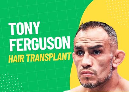 Tony Ferguson Hair Transplant