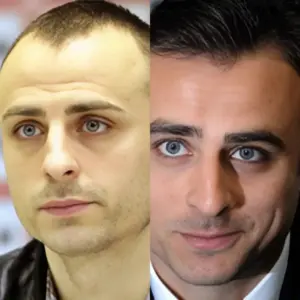 Berbatov Hair Transplant