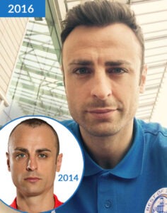 Berbatov Hair Transplant before after