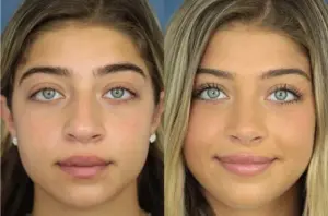 Gia Giudice Nose Job