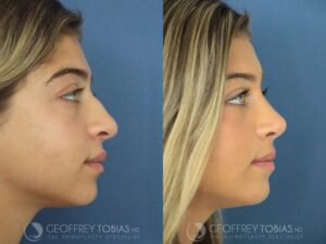 Gia Giudice Nose Job: Before and After