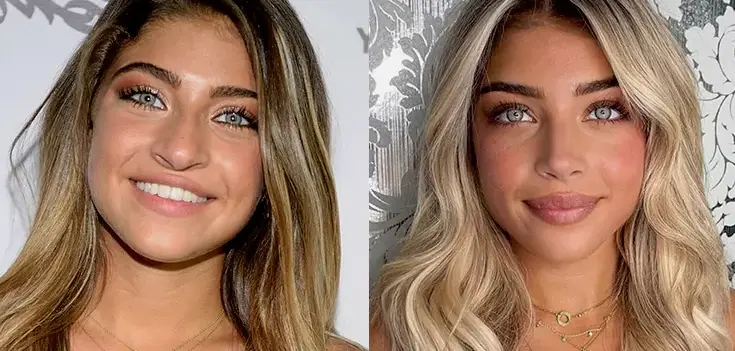 Gia Giudice Nose Job